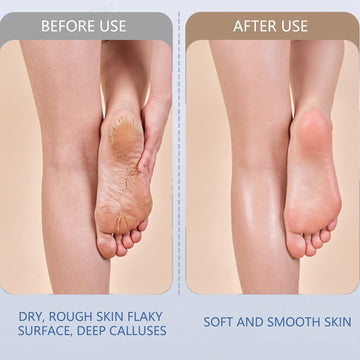 Electric Foot File – Rechargeable Callus Remover | AuriGlam - Anuloria 